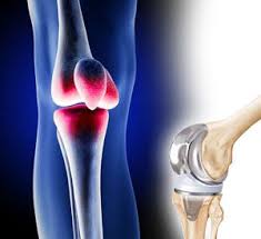 Knee Replacement Medical Device