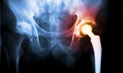 faulty hip replacement